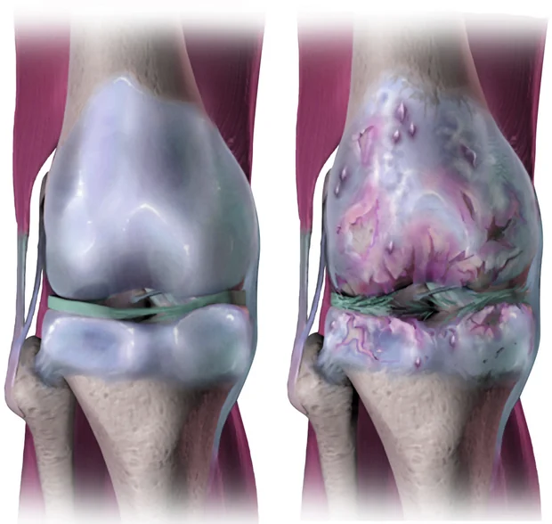 Rodilla sana junto a una rodilla con artrosis, con el cartílago desgastado