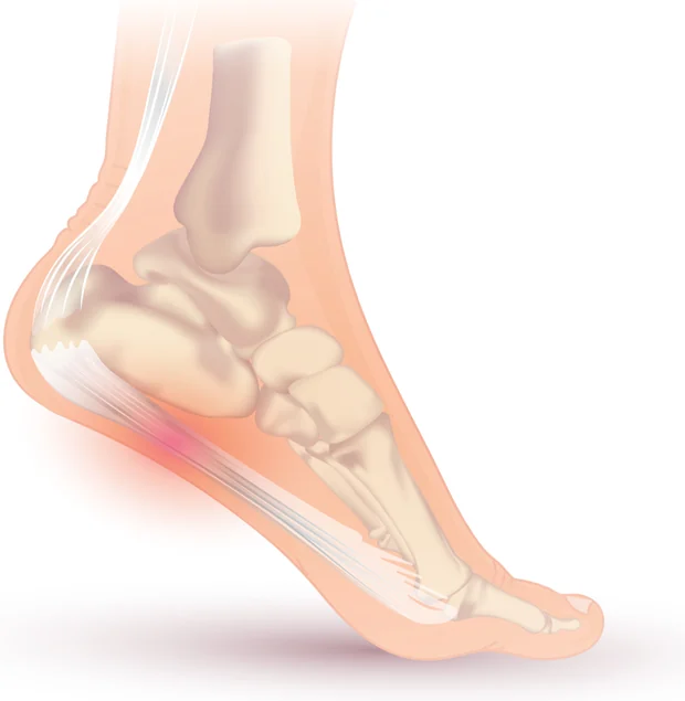 Pie de perfil con el tendón de Aquiles y la fascia plantar inflamada en su inserción del talón