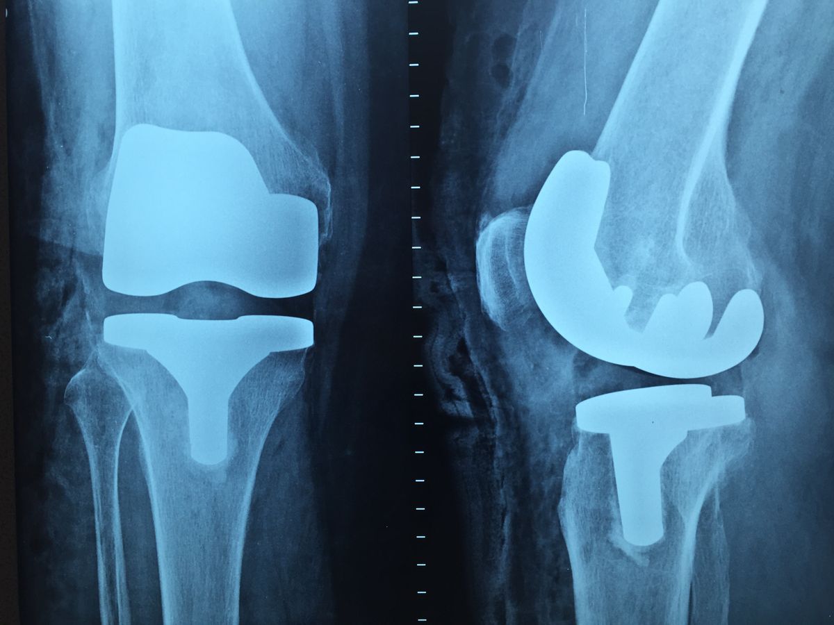 Rehabilitación tras prótesis de rodilla, patología de rodilla que tratamos en la clínica