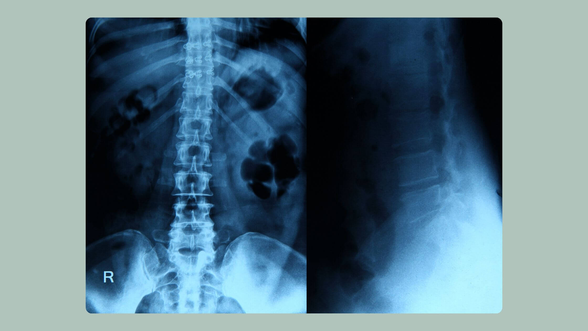 Fisioterapia para el dolor lumbar